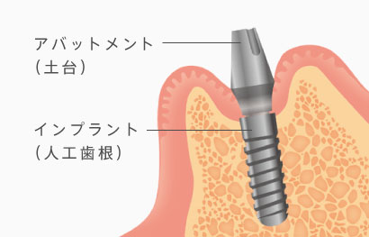 アバットメント（土台）、インプラント（人工歯根）