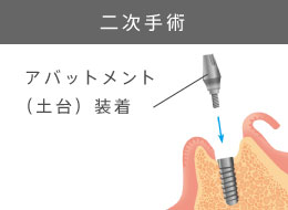 二次手術/アバットメント（土台）装着