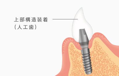 上部構造装着（人工歯）