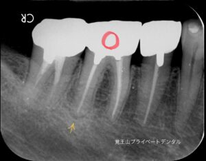 再根管治療_覚王山プライベートデンタル