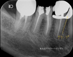 再根管治療